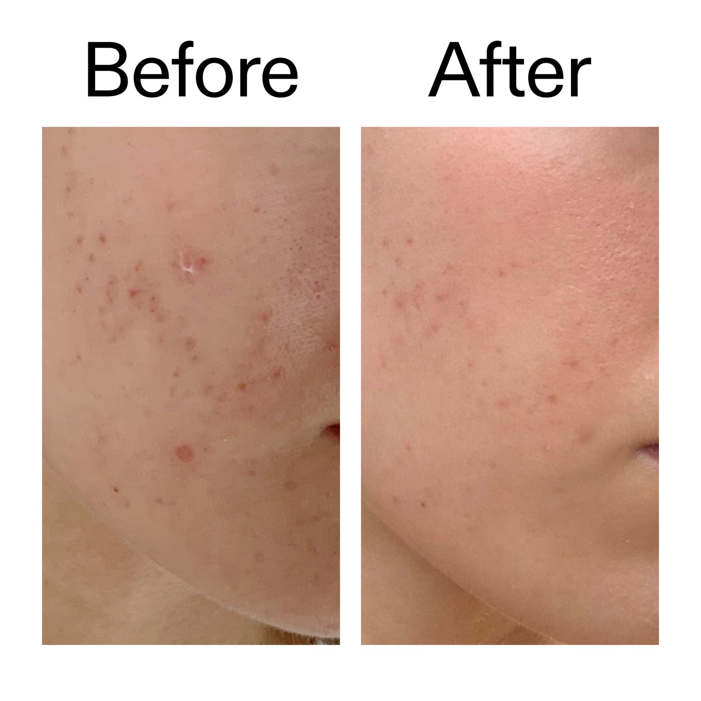 mandelic-acid-treatment-n4 Mandelic_Acid_Treatment_Before_After_2000x2000_4885ac6e-c5d7-4279-a72a-1417af7dce35.jpg