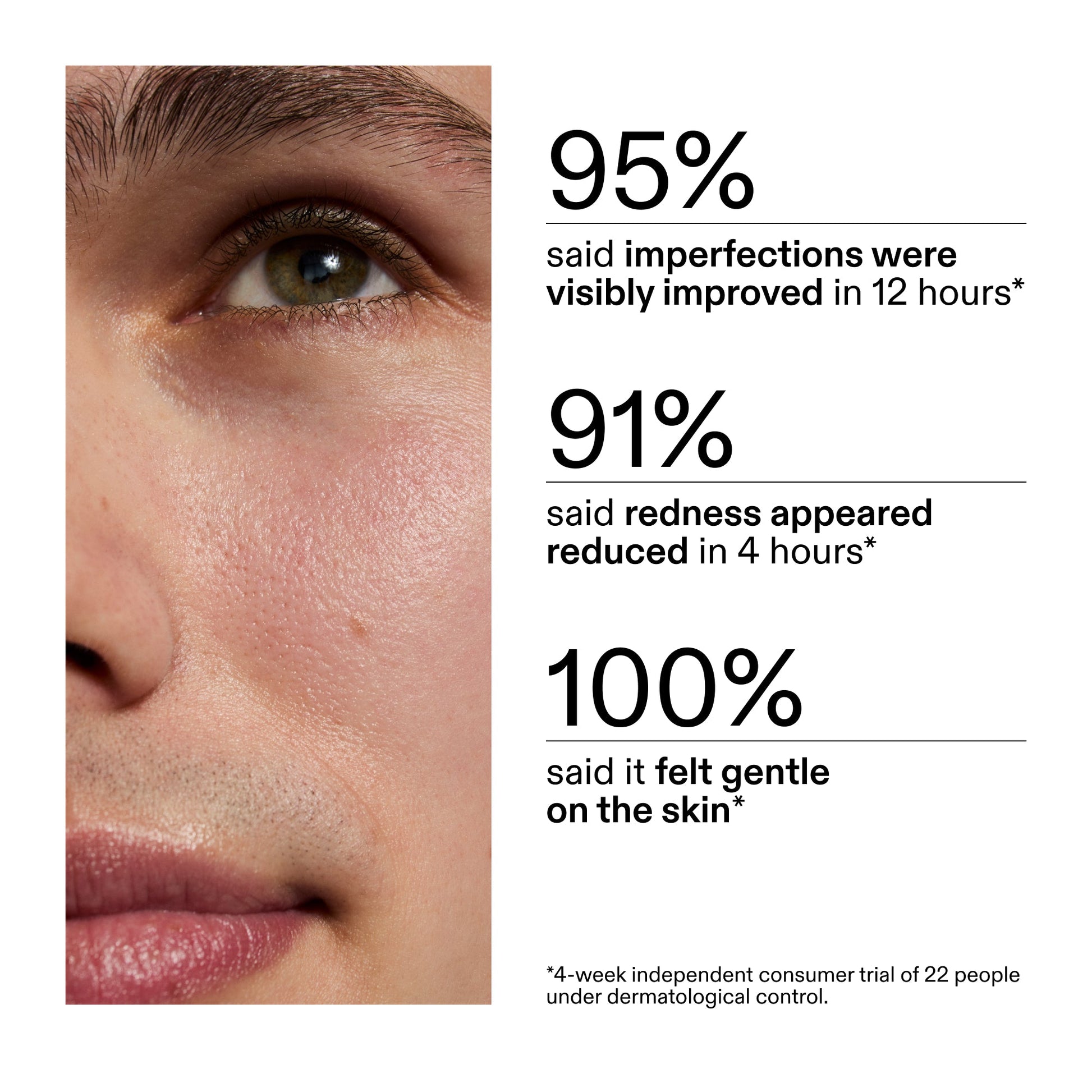 succinic-acid-acne-treatment-j8 CA_Succinic_Acid_Treatment_key_Claims_2000x2000_db91b0f1-7f29-4bfe-bb16-63a47f500960.jpg