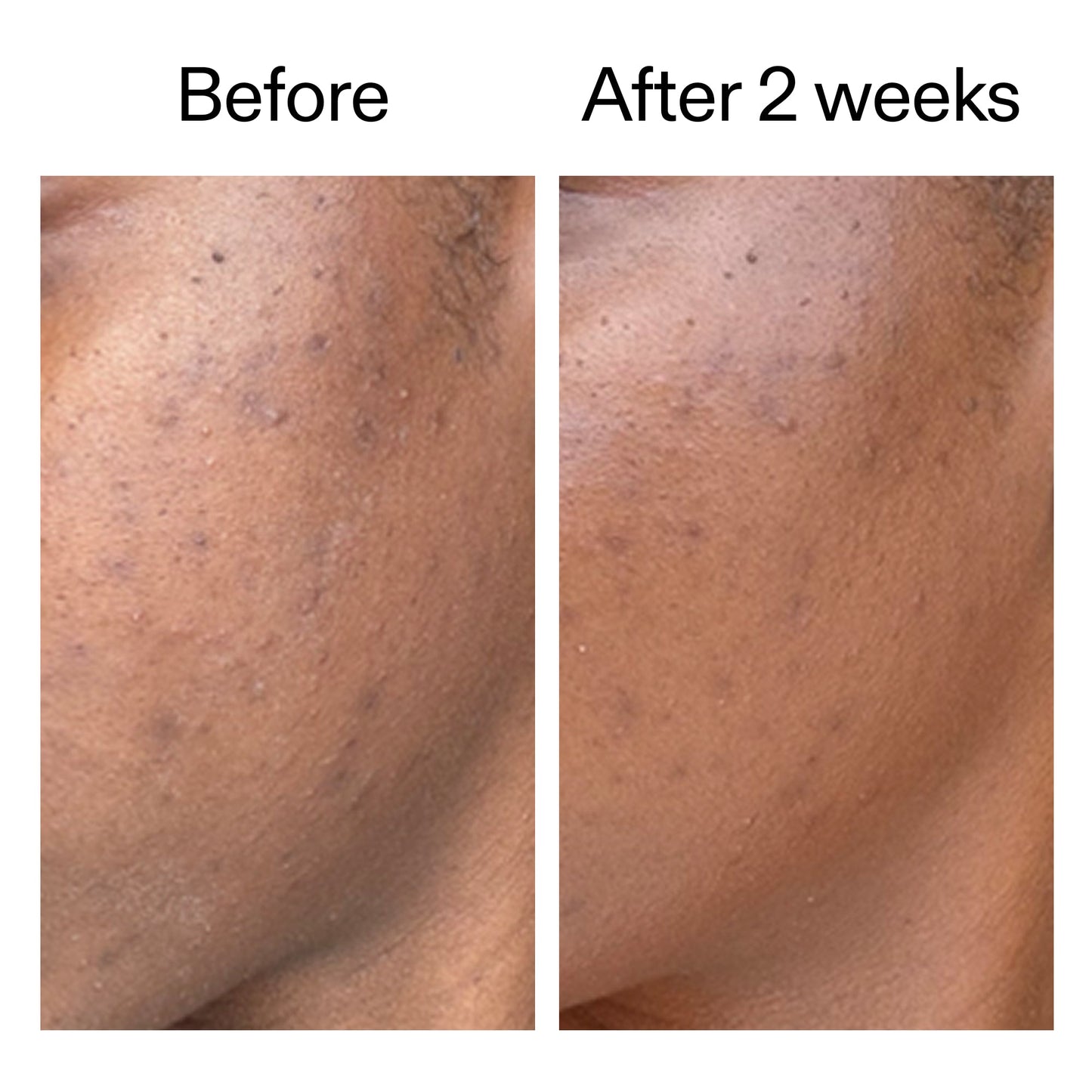 360-acne-clearing-duo-k7 DIOICB_A2000x2000.jpg
