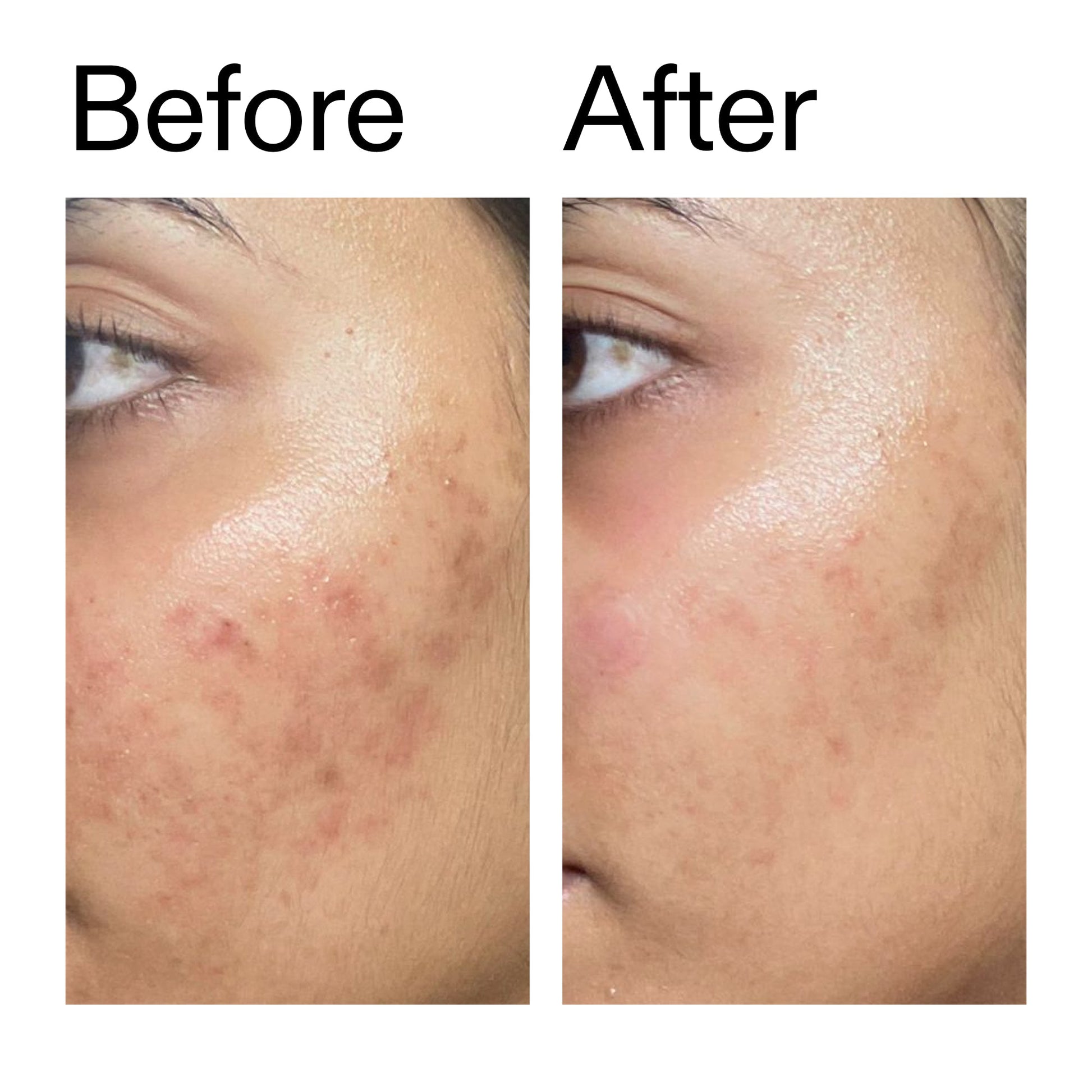 ectoin-hydro-barrier-serum-s2 Ectoin_Hydro-barrier_Serum__Before_After_2000x2000_34261920-d004-48d0-9c7b-8e1c15971bfd.jpg