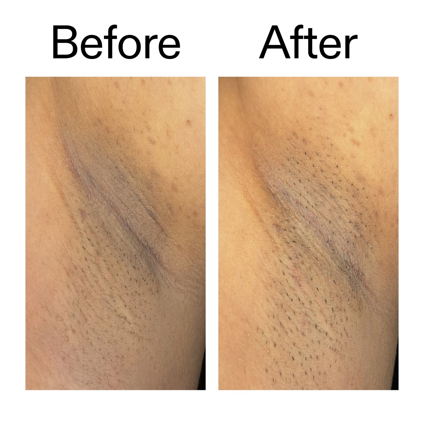 glycolic-acid-exfoliating-body-stick-duo-y7 Glycolic_Acid_Exfoliating_Body_Stick_Before_After_V3_2000x2000_ea919cd9-1439-4a46-82a0-76200eb5bb42.jpg