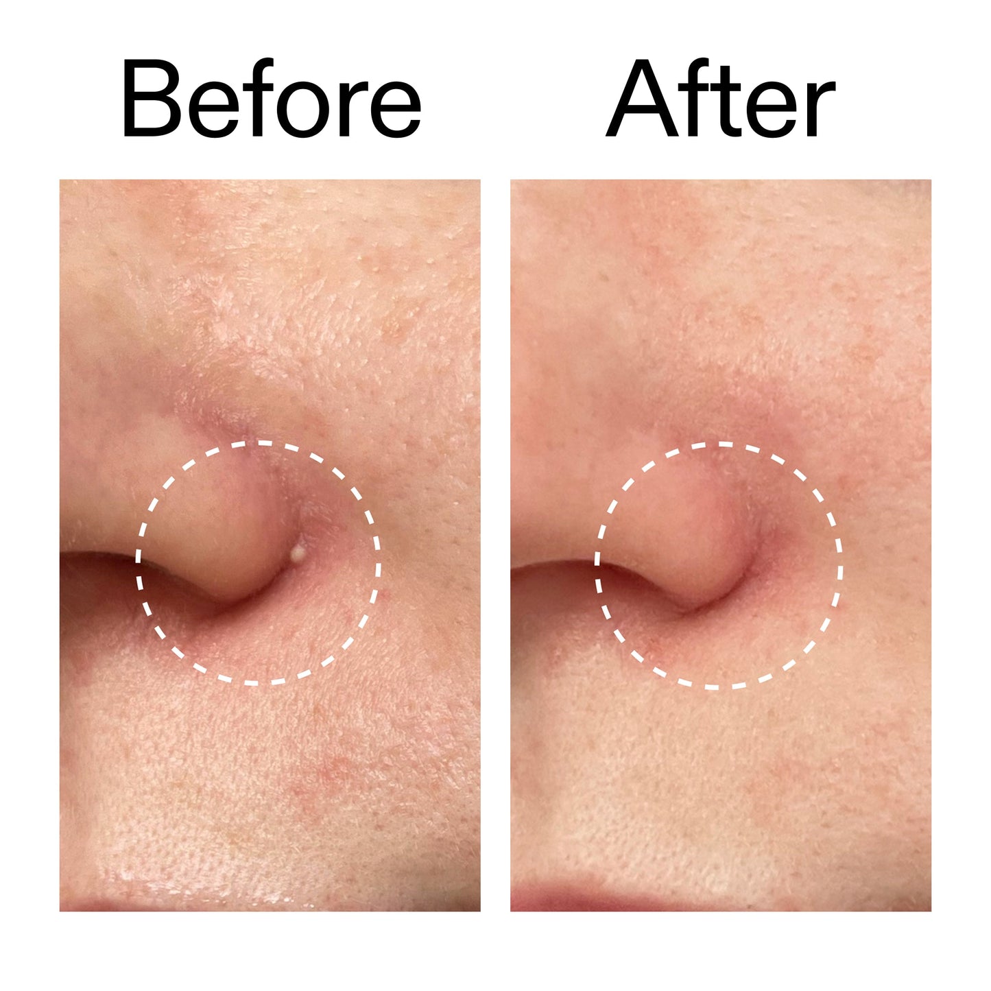 hydrocolloid-invisible-pimple-patches-pack-of-44-o7 Hydrocolloid_Invisible_Pimple_Patches_Before_After_2000x2000_b02aa37b-c78a-4682-91de-9135af5bb7df.jpg