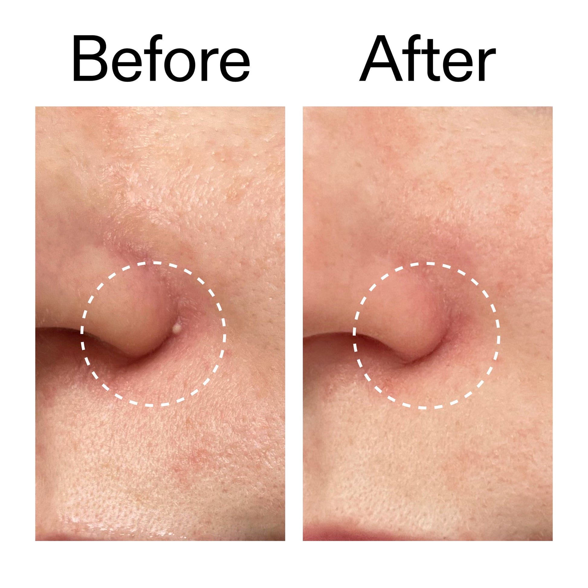 hydrocolloid-invisible-pimple-patches-pack-of-44-o7 Hydrocolloid_Invisible_Pimple_Patches_Before_After_2000x2000_b02aa37b-c78a-4682-91de-9135af5bb7df.jpg