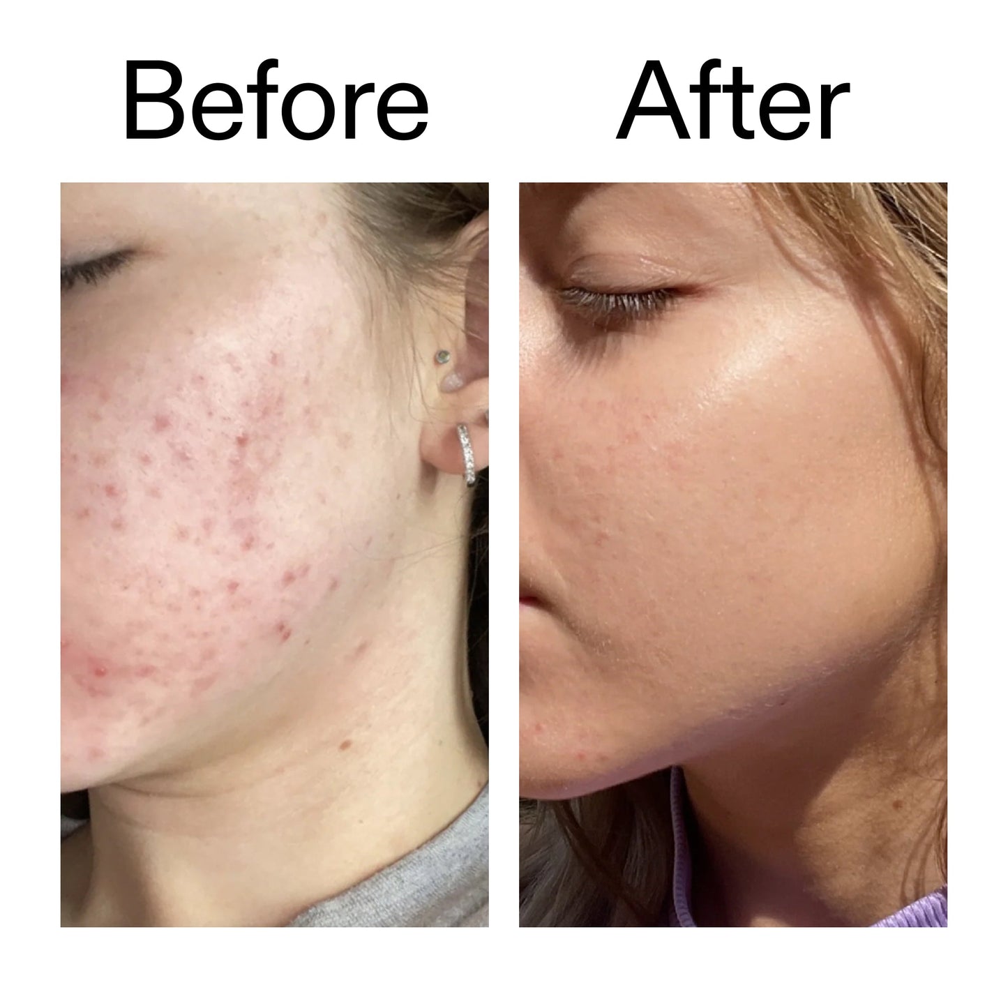10-niacinamide-serum-i9 Niacinamide_Serum_Before_After_2000x2000_bde32455-9e7d-448e-b053-bef41504f0a9.jpg