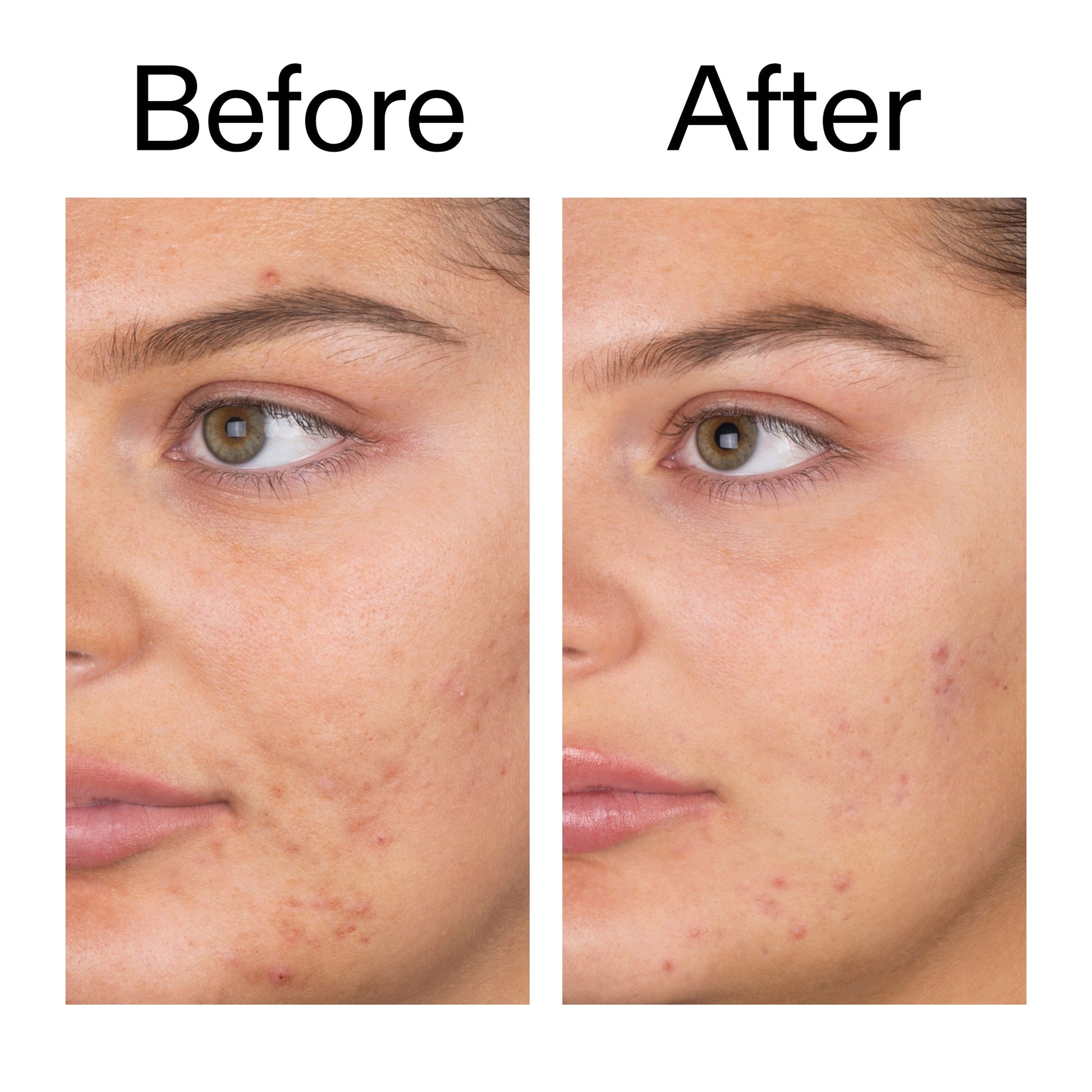 salicylic-acid-cleanser-duo-n7 Salicylic_Acid_Cleanser_-_150ml_Before_After_2000x2000_e7230494-853f-4b07-82b1-27669104c995.jpg