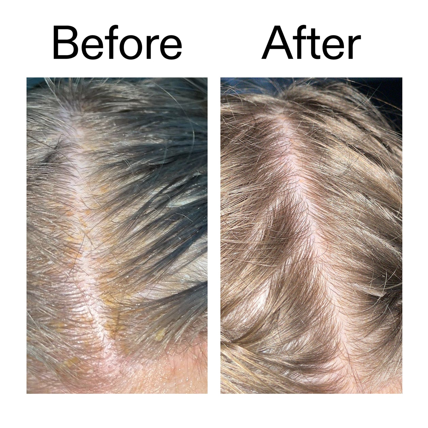 salicylic-acid-exfoliating-scalp-treatment-f9 Salicylic_Acid_Exfoliating_Scalp_Treatment_Before_After_2000x2000_e572a30f-057c-4a48-823b-1c09dc97f8d0.jpg