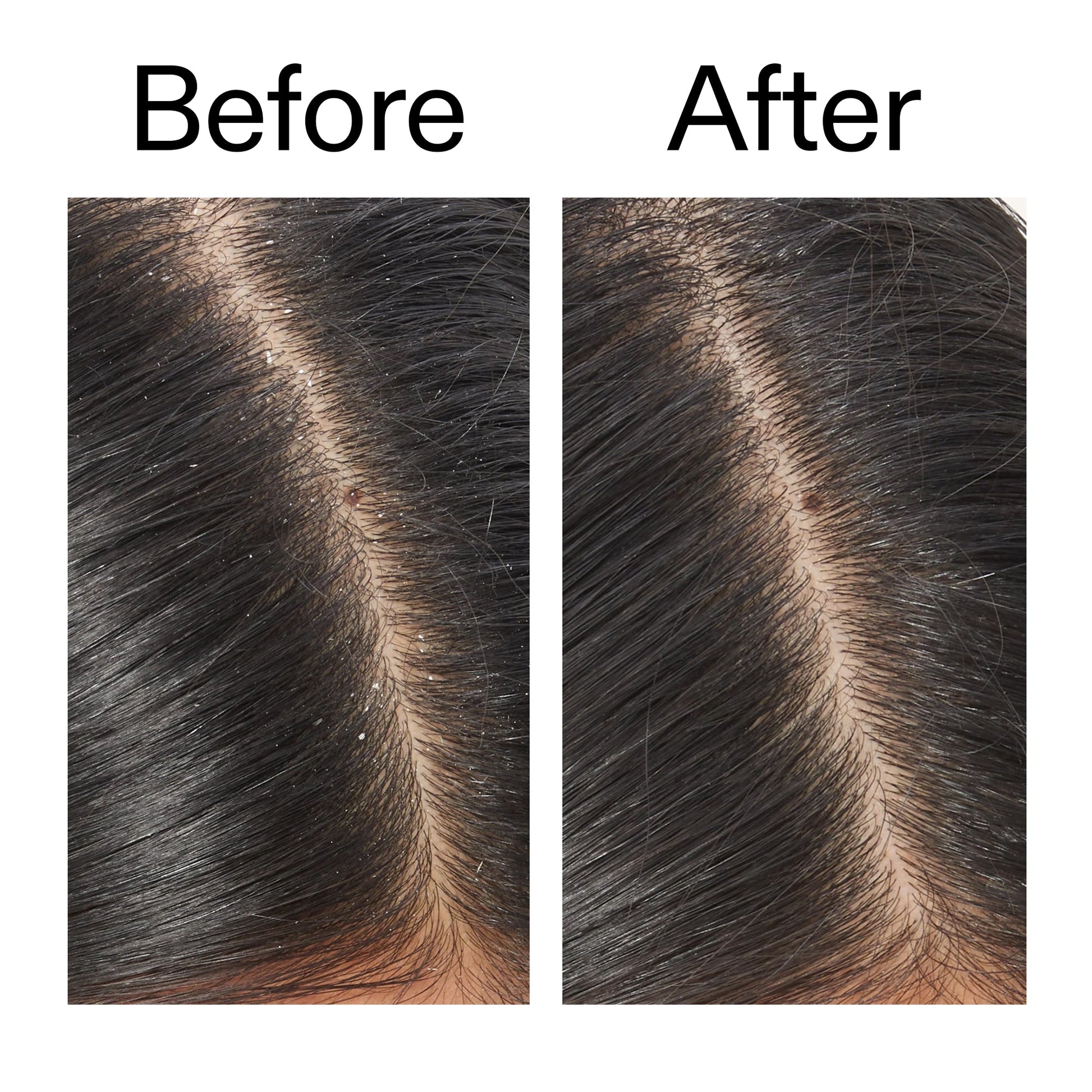 salicylic-acid-exfoliating-scalp-treatment-f9 Salicylic_Acid_Exfoliating_Scalp_Treatment_Before_After_V2_2000x2000_02bd61ad-42bf-490b-b3e3-7e04b2e8a673.jpg