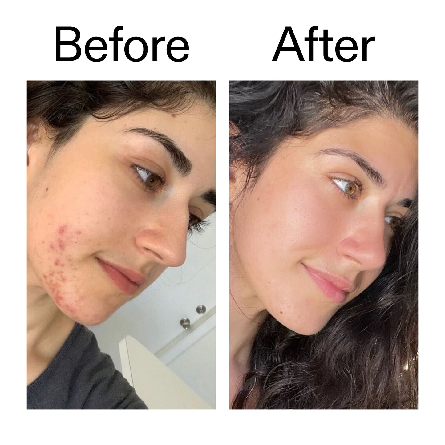 succinic-acid-acne-treatment-j8 Succinic_Acid_Treatment_Before_After_2000x2000_6a5f0054-2f58-4433-9314-0dc72c9bdd3b.jpg