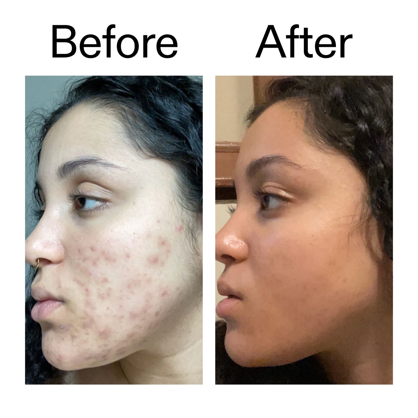 tranexamic-acid-serum-k8 Tranexamic_Acid_Serum_Before_After_2000x2000_98ebc8be-77b0-4843-8a22-90790ebe918b.jpg